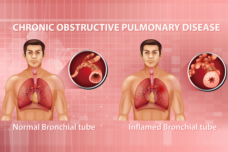 COPD Treatment Doctors in Pitampura