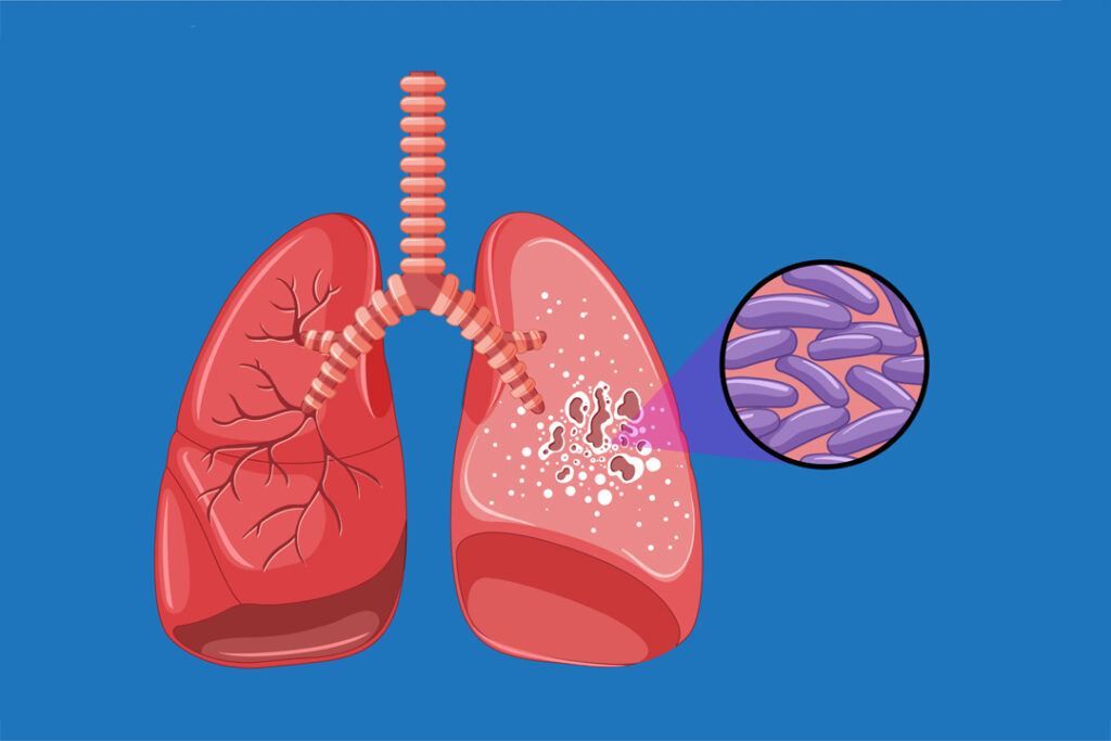 Best Tuberculosis Treatment Doctors in Pitampura